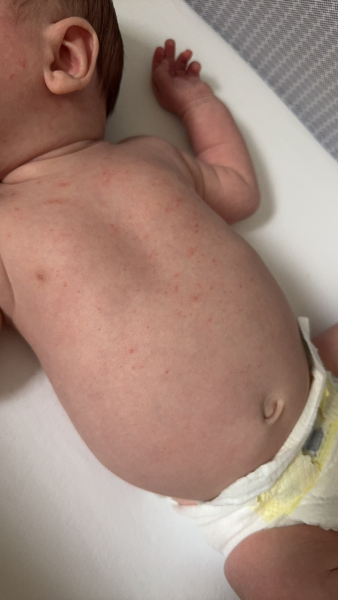 Rash on 5 week old