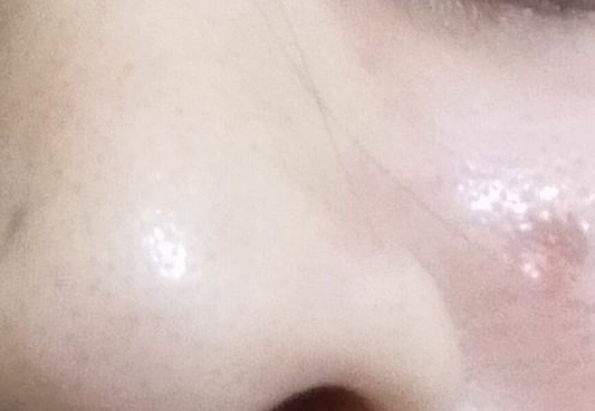 Chicken pox pock marks- the after scars! 