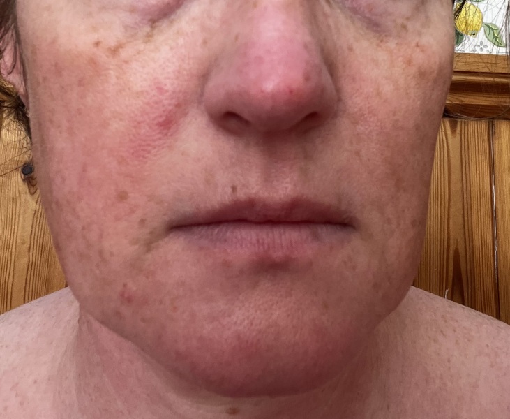 Laser, IPL or what for this redness?