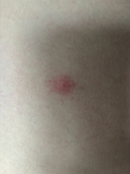 What are these spots