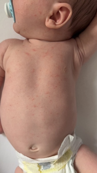 Rash on 5 week old