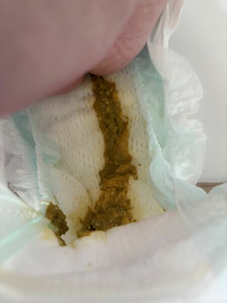 Could this possibly be CMPA? *TMI picture of baby poo