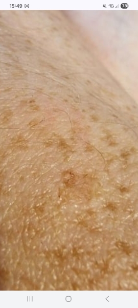 Does this look like skin cancer?