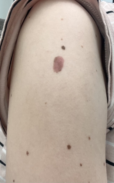 Fairly certain skin cancer?