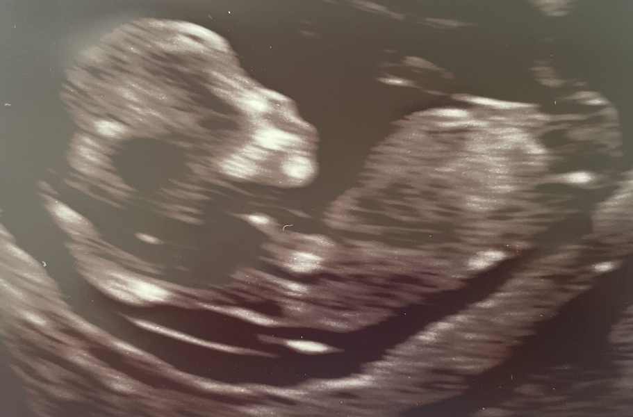 Boy or Girl?