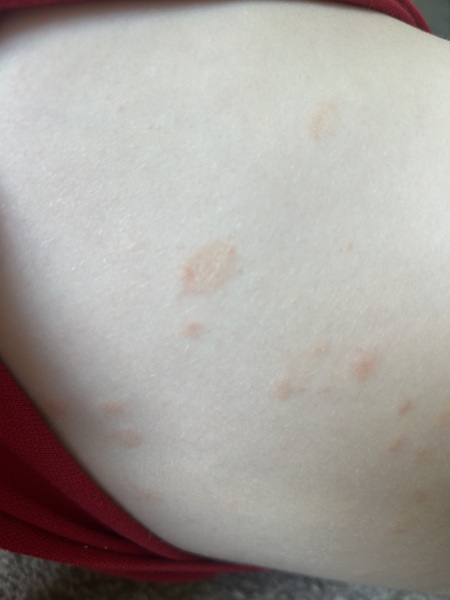 Rash on my son’s skin