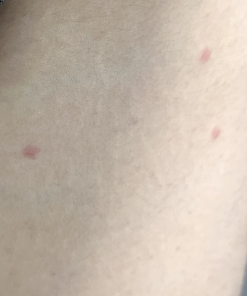 Small red spots on body 9 weeks pregnant