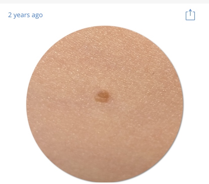 Worried about dodgy looking mole!