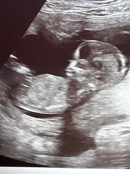 Girl or boy? I don't really understand nub/skull theories