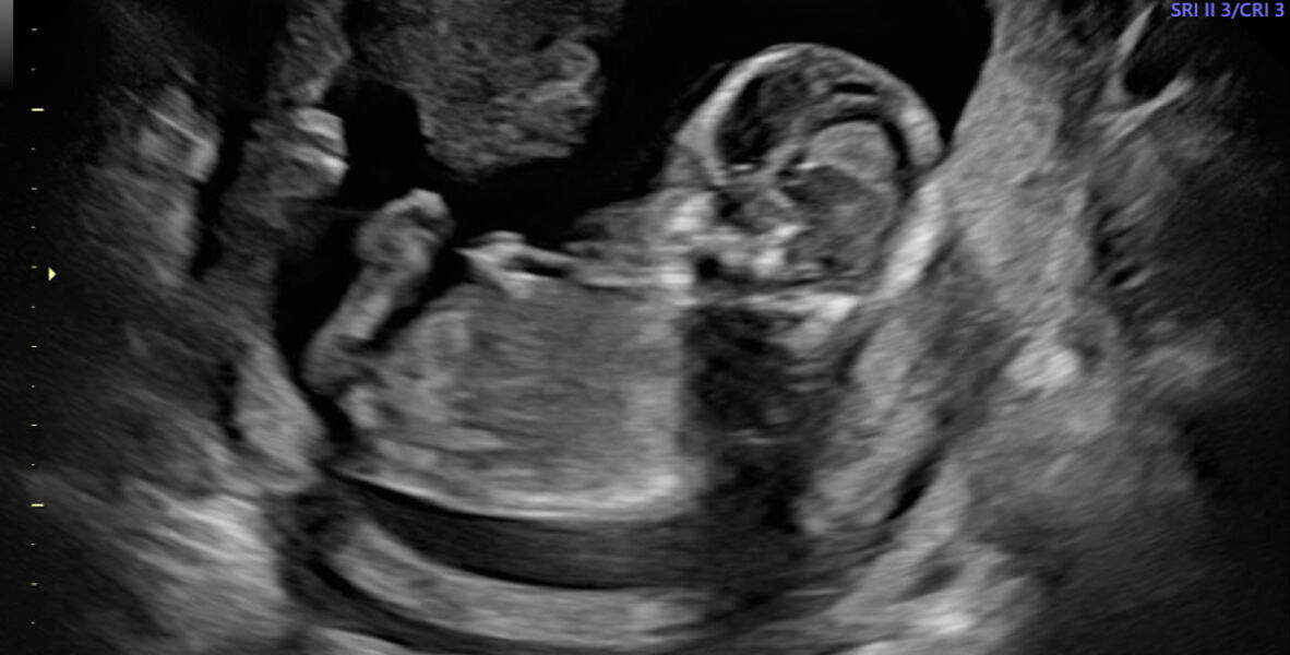 It’s a BOY! But sooo confused about what the scan picture shows…please help!