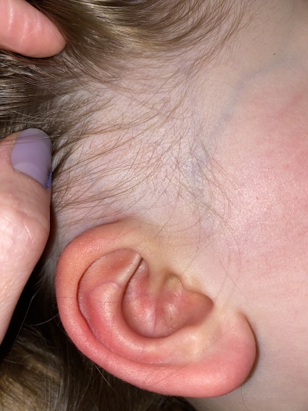 Hair loss 4 year old girl