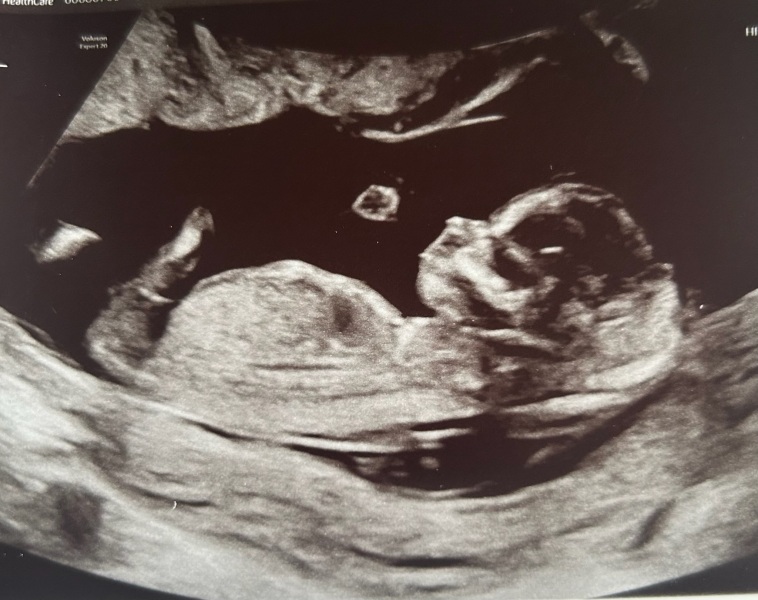 Nub theory scan help! Can you help me guess the gender of my baby?