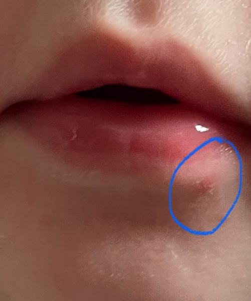 Does this look like the start of a cold sore on my 1yr old?!
