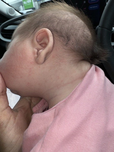 Does anyone know if this rash looks like CMPA?