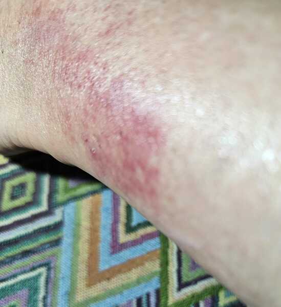 Itchy......