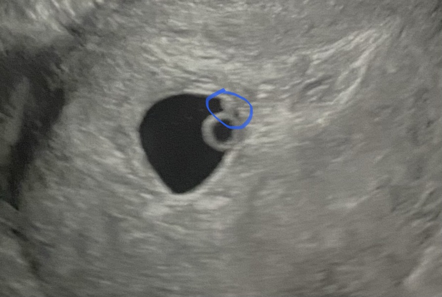 Is this the fetal pole?