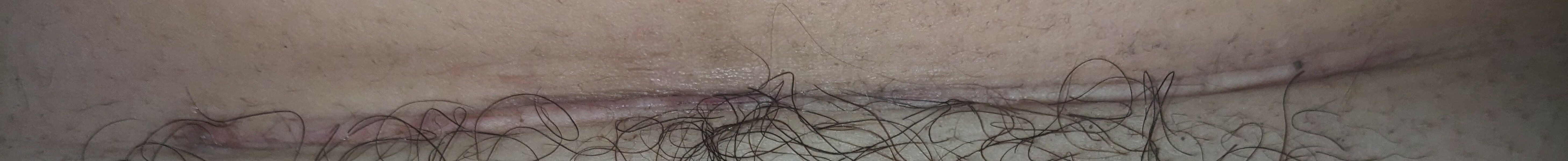 Is my C-section incision opening?