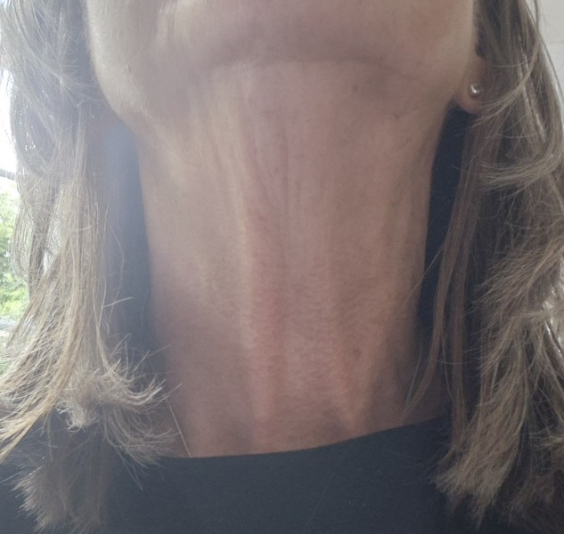 Anyone had Botox or treatment for 'turkey neck'?