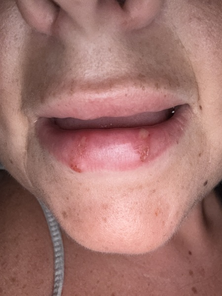 IS IT A Cold sore or SUNBURN