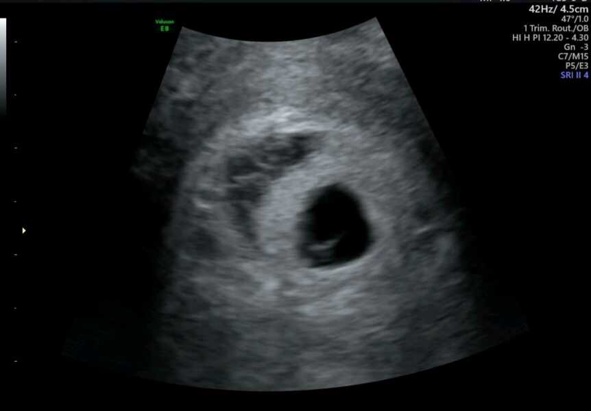 Subchorionic hematoma