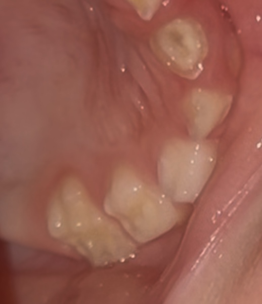 super concerned about my DD teeth