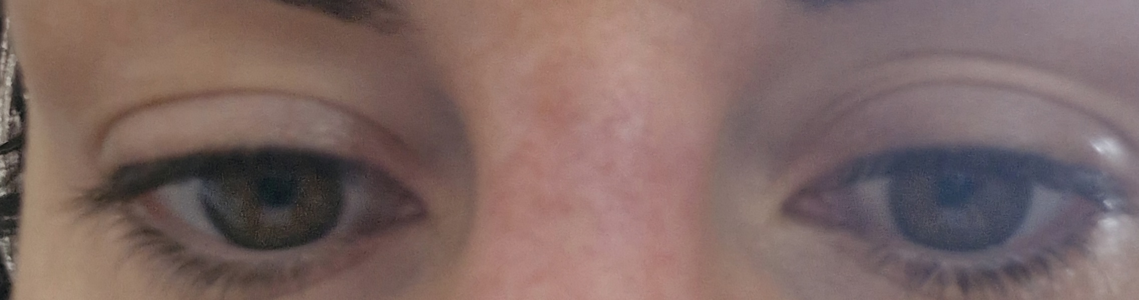 Discolouration on nose 2 weeks after filler- concerned