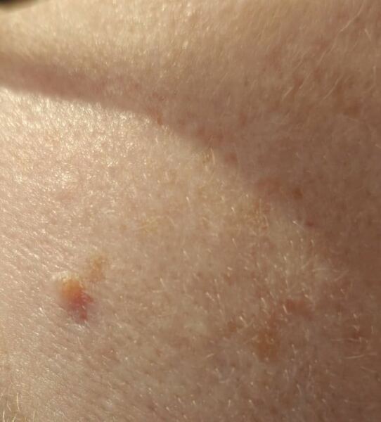 Thoughts on this mole?