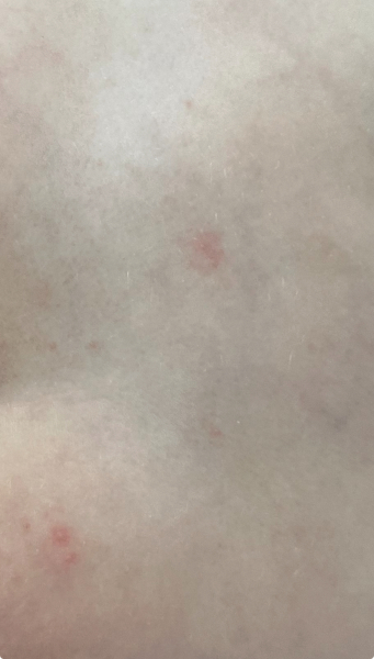 Does this look like chicken pox?