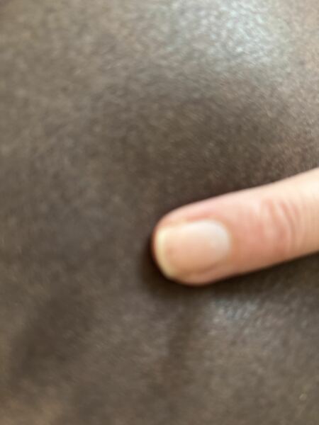 Splinter under nail