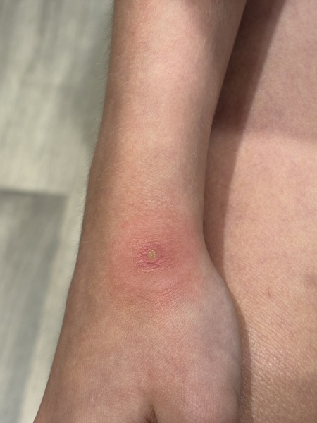 What bug bite is this?