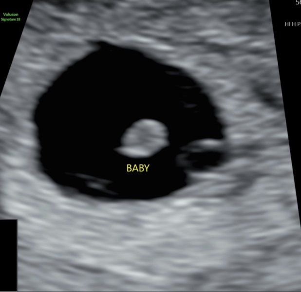 8 weeks 2 days but measuring 5 weeks 3 days??