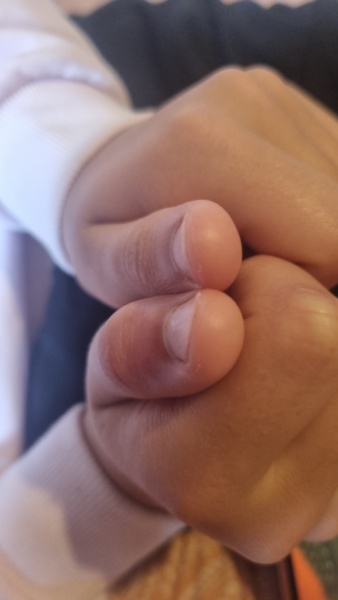 Thumb trapped in car door