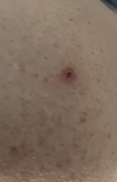 Dodgy mole?