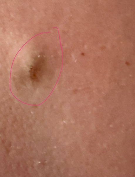 Skin cancer ?