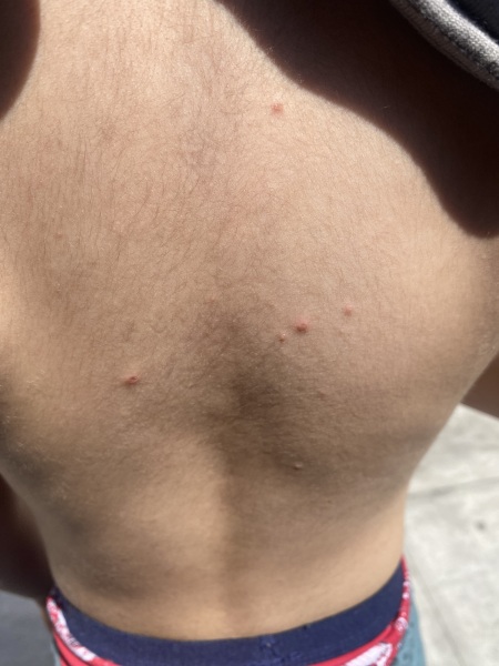 38 weeks pregnant and think DS has chickenpox