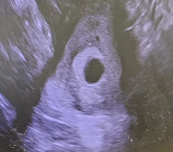Confused and scared - early pregnancy scan not showing anything