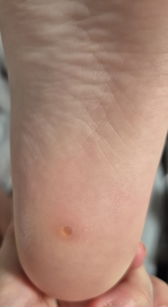 What is this on my 6 year oldest heel?