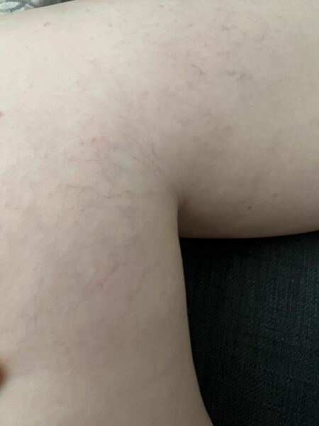 Spider veins on legs - how to get rid!?