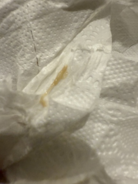Is this looks like implantation *TW Graphic image*