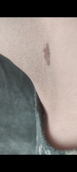 Worried about this mole