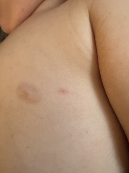 Chicken pox