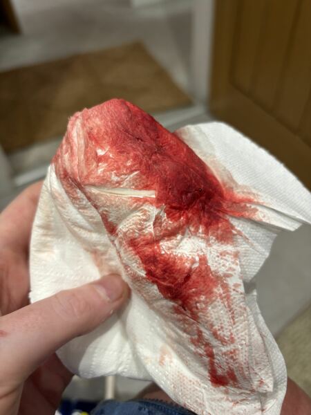 ? Bleeding in early pregnancy ? Chemical pregnancy