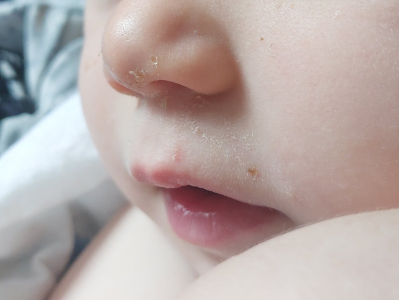 Is this a coldsore on my toddler?