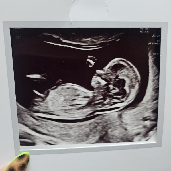 Ultrasound