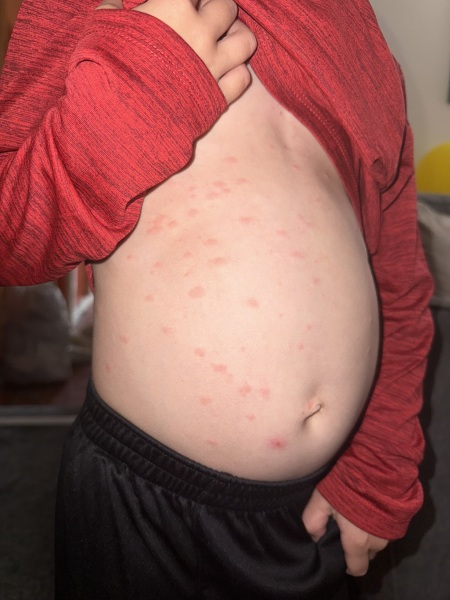 Chickenpox after 1 vaccine, any experiences?!
