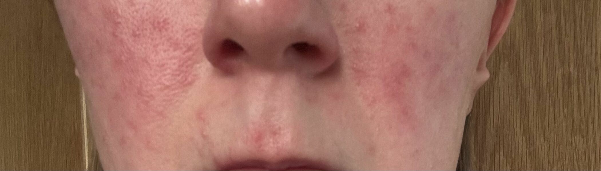 Is this rosacea and how do I get rid?