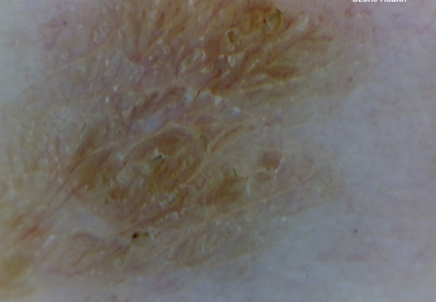 Mole pictures - does this look worrying to you?