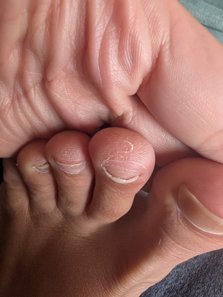 Toenails falling off and bulbus tip (pics attached)