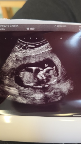 Ultrasound