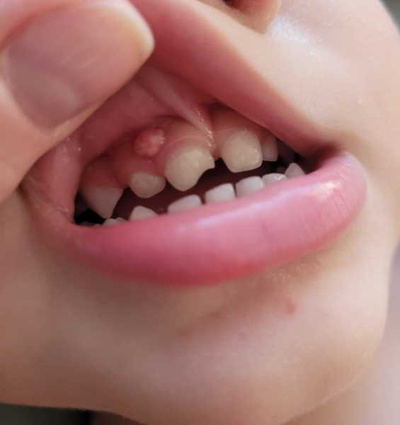 Any dentists? Big fleshy lump on toddlers gum (picture.)